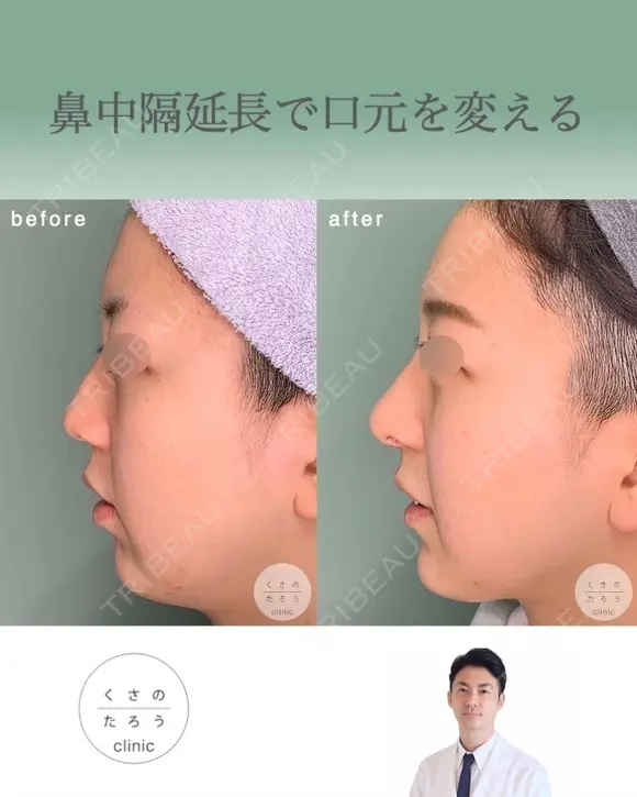 鼻中隔延長で口元をきれいにする after画像 メイン用