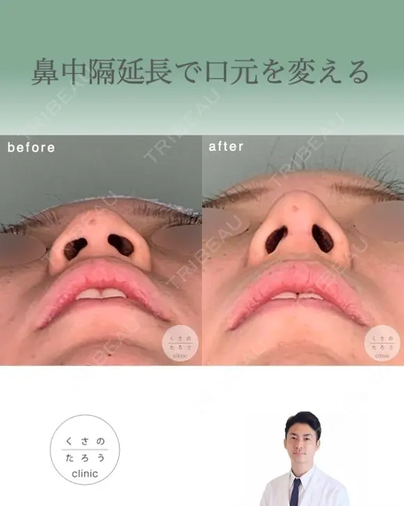 鼻中隔延長で口元をきれいにする after画像 メイン用