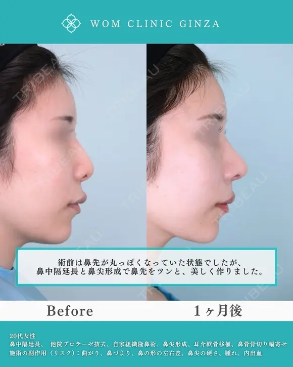 より美しく、理想の鼻を創る 30日後 メイン用