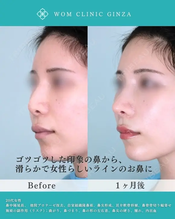 より美しく、理想の鼻を創る 30日後 メイン用