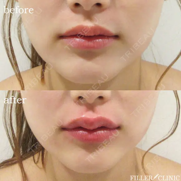 スマイルリップ(唇ヒアル+口角ボト) after画像 メイン用