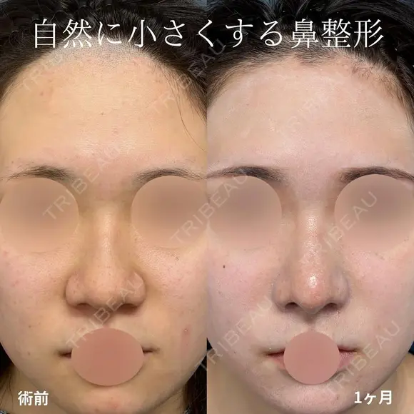 鼻尖形成、軟骨移植、鼻柱下降、鼻翼縮小、プロテーゼ、鼻孔縁挙上 after画像 メイン用