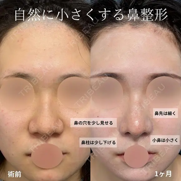 鼻尖形成、軟骨移植、鼻柱下降、鼻翼縮小、プロテーゼ、鼻孔縁挙上 before画像 メイン用