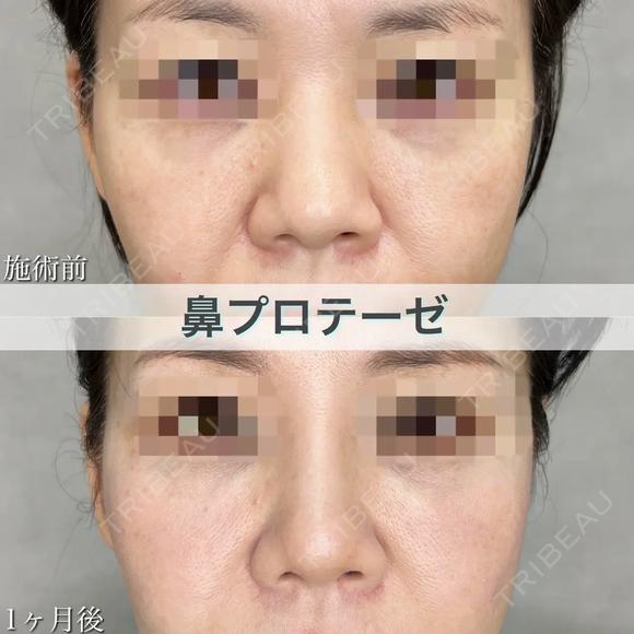鼻プロテーゼで理想の高さに😍🌷✨隆鼻術 before画像 メイン用