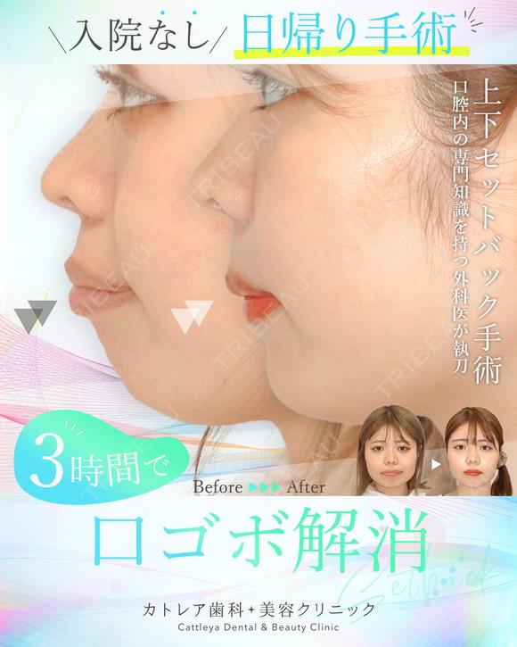 出っ歯🦷口元の膨らみ💋上下セットバック 90日後 メイン用