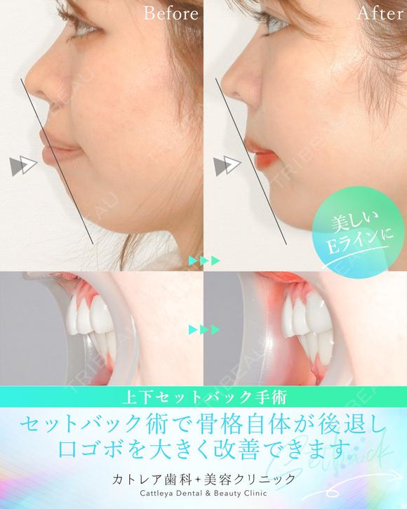出っ歯🦷口元の膨らみ💋上下セットバック 90日後 メイン用