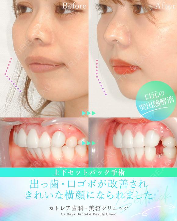 出っ歯🦷口元の膨らみ💋上下セットバック 90日後 メイン用