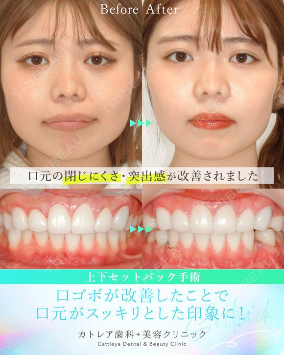出っ歯🦷口元の膨らみ💋上下セットバック 90日後 メイン用