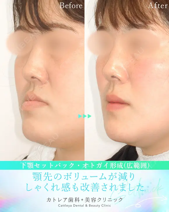 受け口・反対のかみ合わせ🦷下顎セットバック 180日後 メイン用