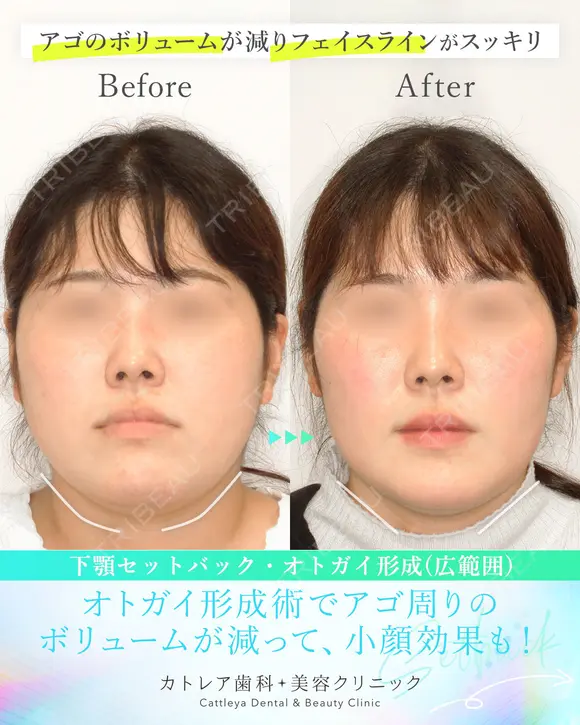 受け口・反対のかみ合わせ🦷下顎セットバック 180日後 メイン用