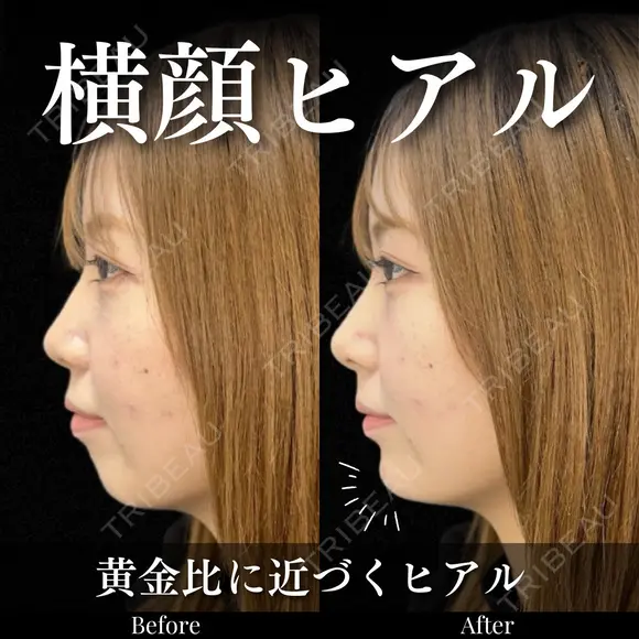 顎ヒアルロン酸×鼻先ヒアルロン酸 after画像 メイン用