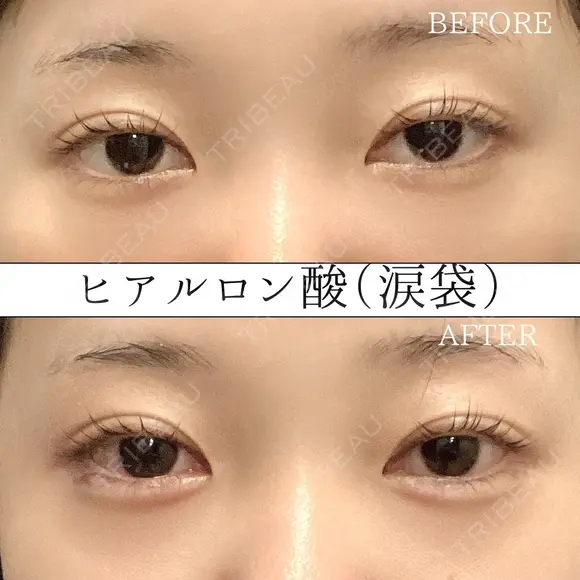涙袋ヒアルロン酸 注入術 before画像 メイン用