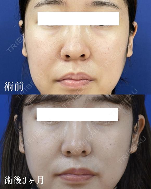 鼻尖縮小 before画像 メイン用