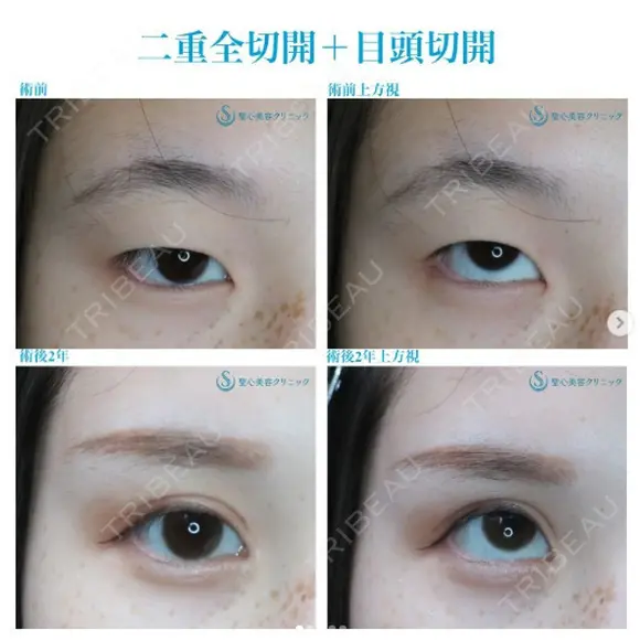 【20代女性（施術当時は10代）・アイプチ卒業】二重全切開＋目頭切開手術（2年後） after画像 メイン用