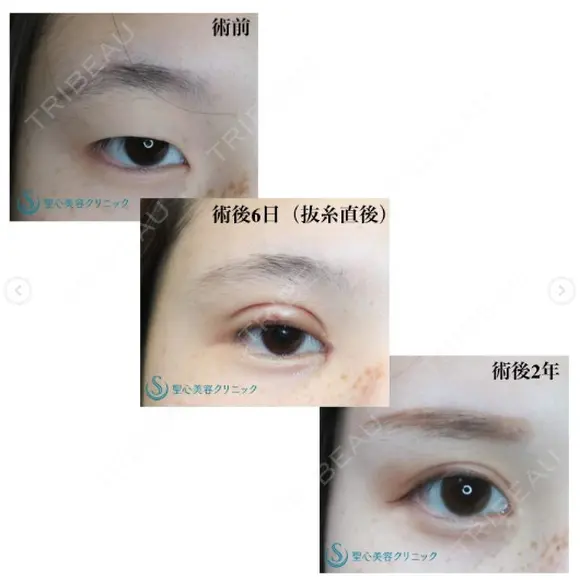 【20代女性（施術当時は10代）・アイプチ卒業】二重全切開＋目頭切開手術（2年後） after画像 メイン用