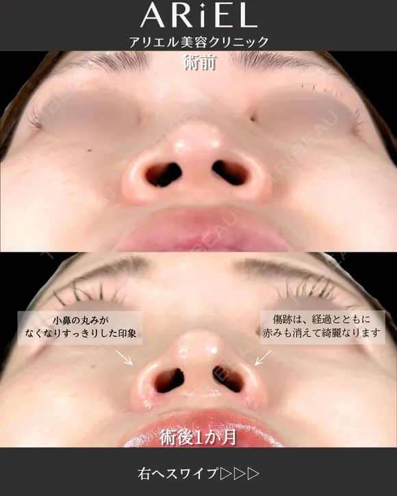 小鼻縮小内側・鼻孔縁挙上 before画像 メイン用