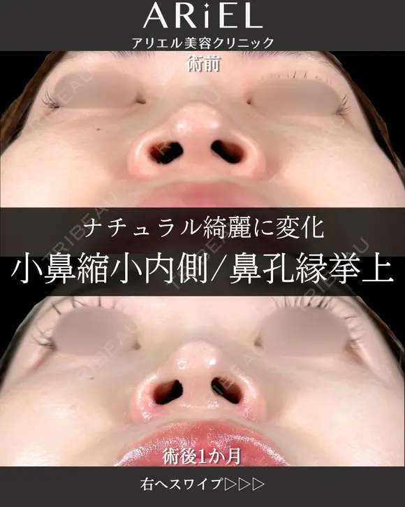 小鼻縮小内側・鼻孔縁挙上 30日後 メイン用