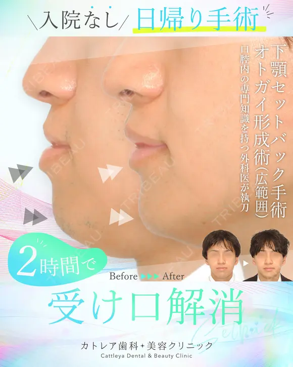受け口、反対のかみ合わせ🦷下顎セットバック 90日後 メイン用