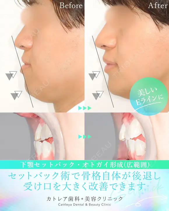受け口、反対のかみ合わせ🦷下顎セットバック 90日後 メイン用