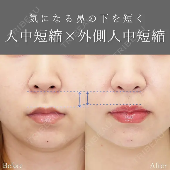 人中短縮術 before画像 メイン用