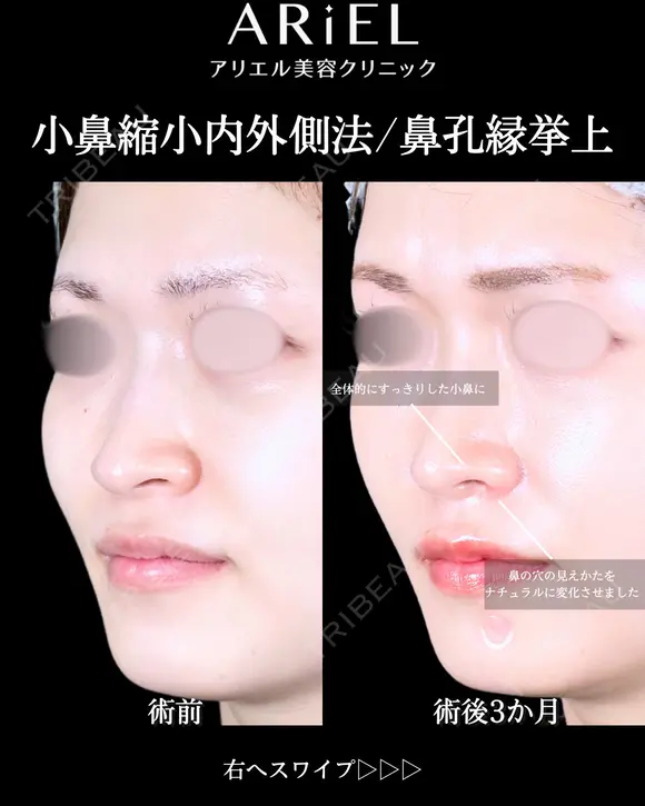 小鼻縮小内側・鼻孔縁挙上 before画像 メイン用