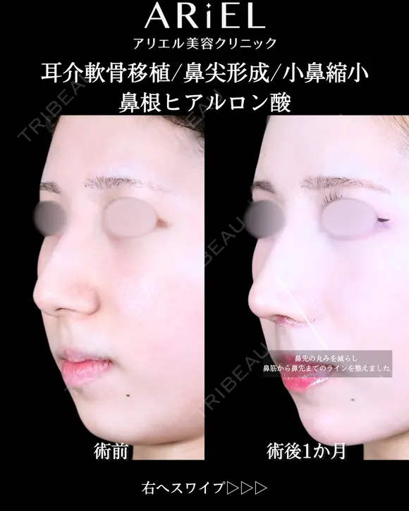 軟骨移植 /軟骨トリム/鼻尖形成 /小鼻縮小 /フラップ固定/鼻根ヒアルロン酸 before画像 メイン用