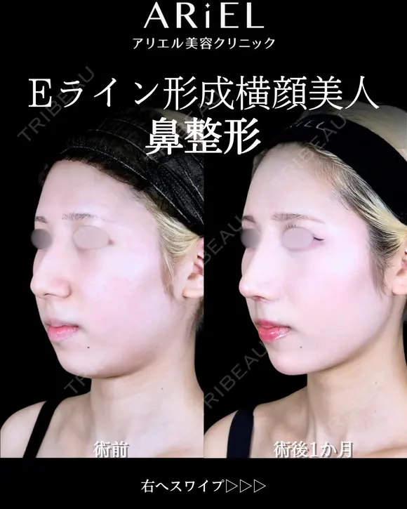 軟骨移植 /軟骨トリム/鼻尖形成 /小鼻縮小 /フラップ固定/鼻根ヒアルロン酸 30日後 メイン用