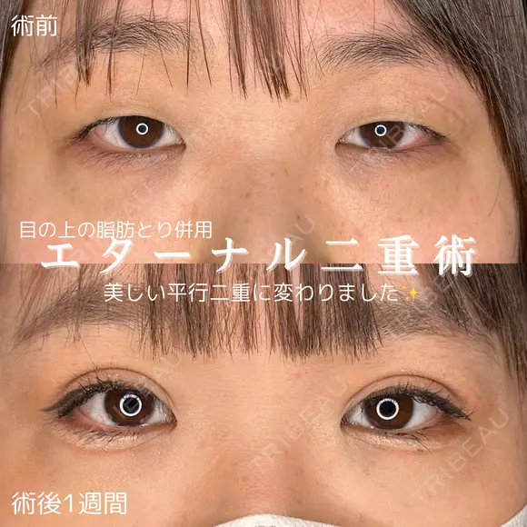 エターナル二重術+まぶたの上の脂肪取り before画像 メイン用