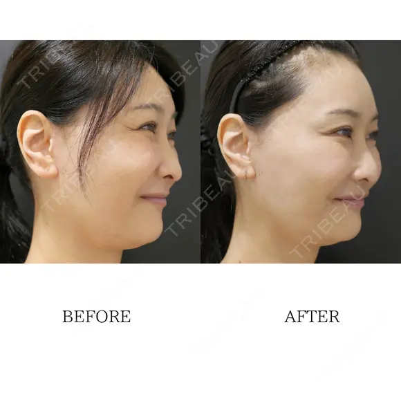 【院長施術】ボトックス注射【目尻、口角、人中】 before画像 メイン用