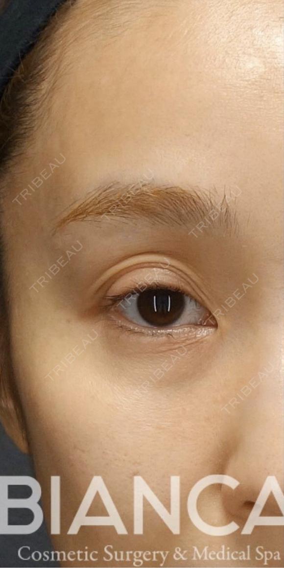 【目を美しくする治療👀✨】 before画像 メイン用