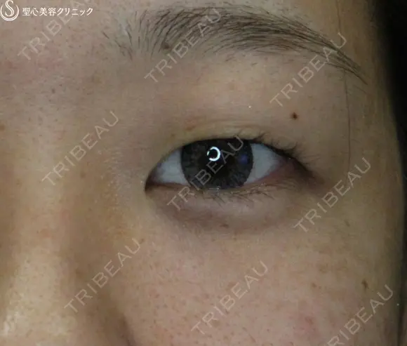 【20代女性・腫れは最低限】腫れにくい二重術　マイクロメソッド＋α before画像 メイン用