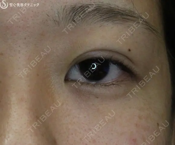 【20代女性・腫れは最低限】腫れにくい二重術　マイクロメソッド＋α after画像 メイン用
