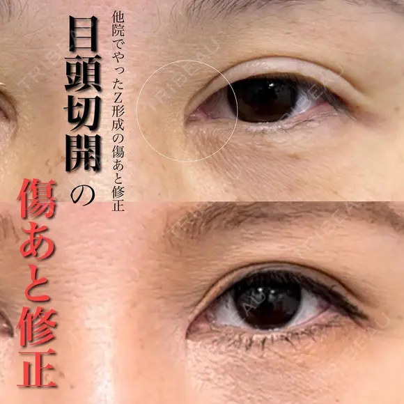 目頭切開の傷跡修正 after画像 メイン用