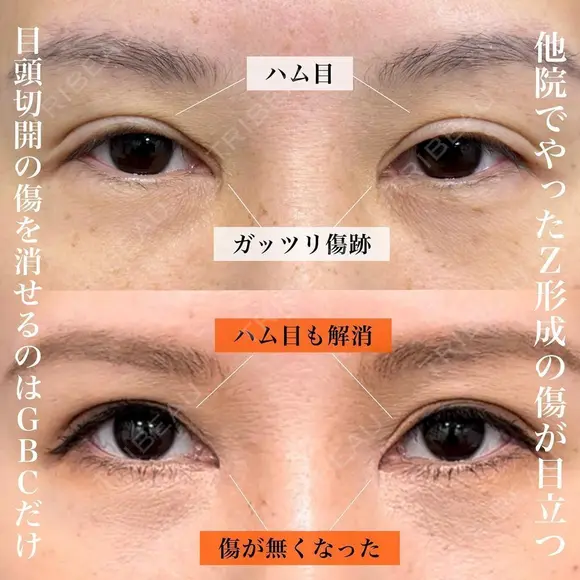 目頭切開の傷跡修正 before画像 メイン用