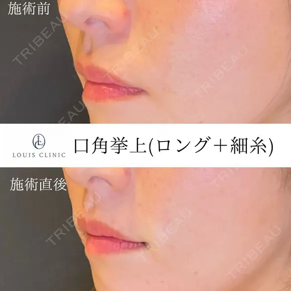 口角挙上(ロング＋細糸) before画像 メイン用