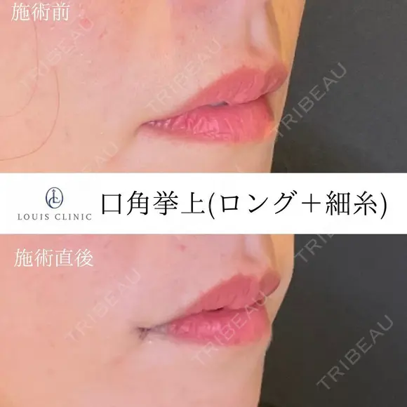 口角挙上(ロング＋細糸) after画像 メイン用