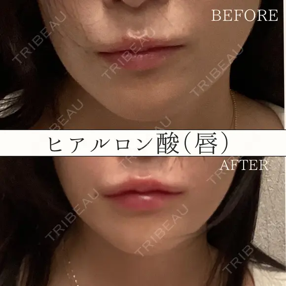 唇ヒアルロン酸 注入術 before画像 メイン用