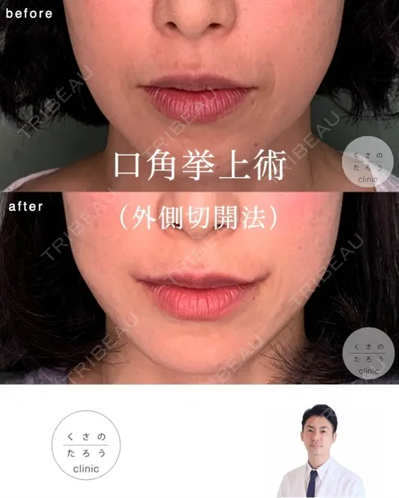口角挙上 before画像 メイン用