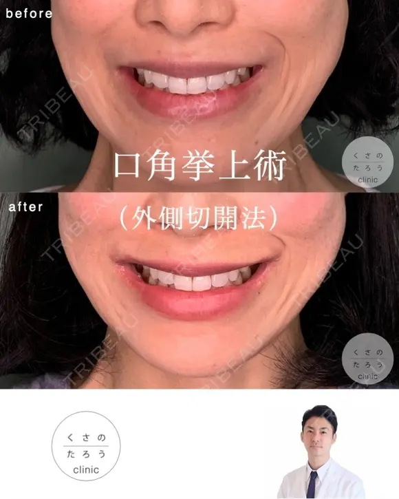 口角挙上 after画像 メイン用