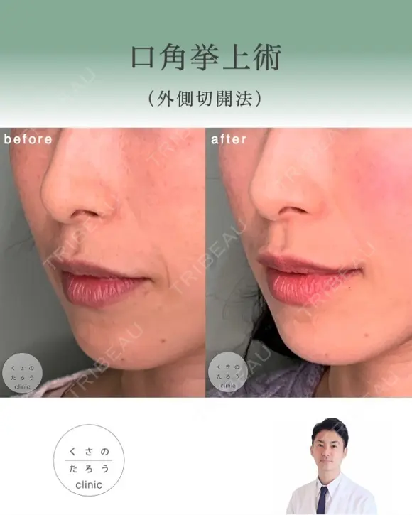 口角挙上 after画像 メイン用