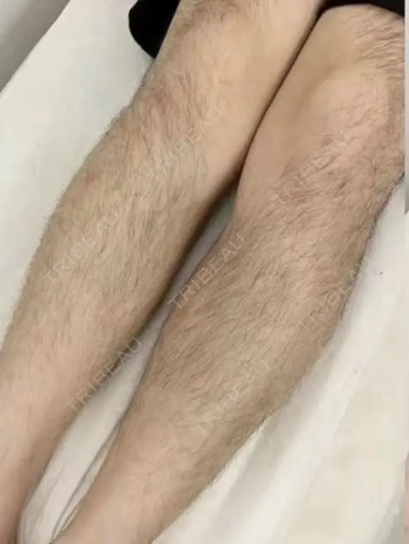 医療脱毛 before画像 メイン用