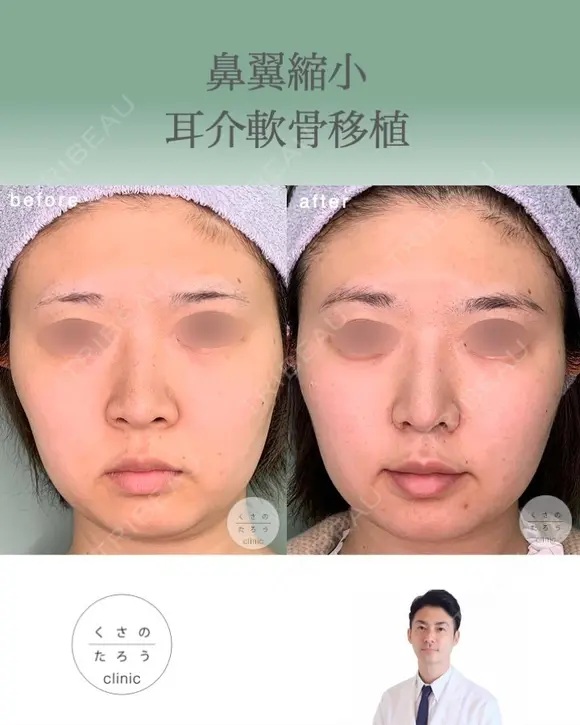 鼻翼縮小＋耳介軟骨移植 before画像 メイン用