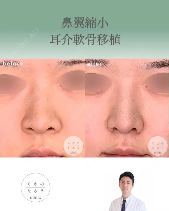 鼻翼縮小＋耳介軟骨移植 after画像 メイン用
