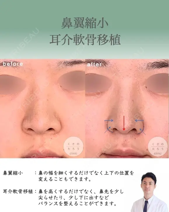 鼻翼縮小＋耳介軟骨移植 after画像 メイン用