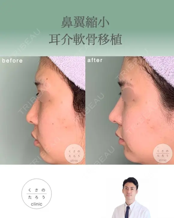 鼻翼縮小＋耳介軟骨移植 after画像 メイン用