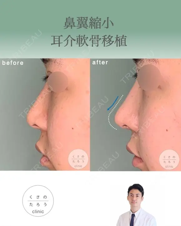 鼻翼縮小＋耳介軟骨移植 after画像 メイン用