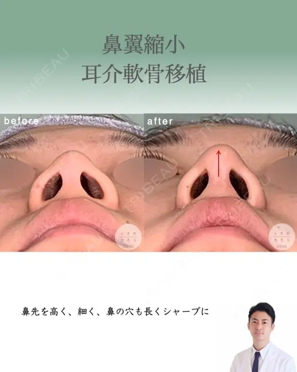 鼻翼縮小＋耳介軟骨移植 after画像 メイン用