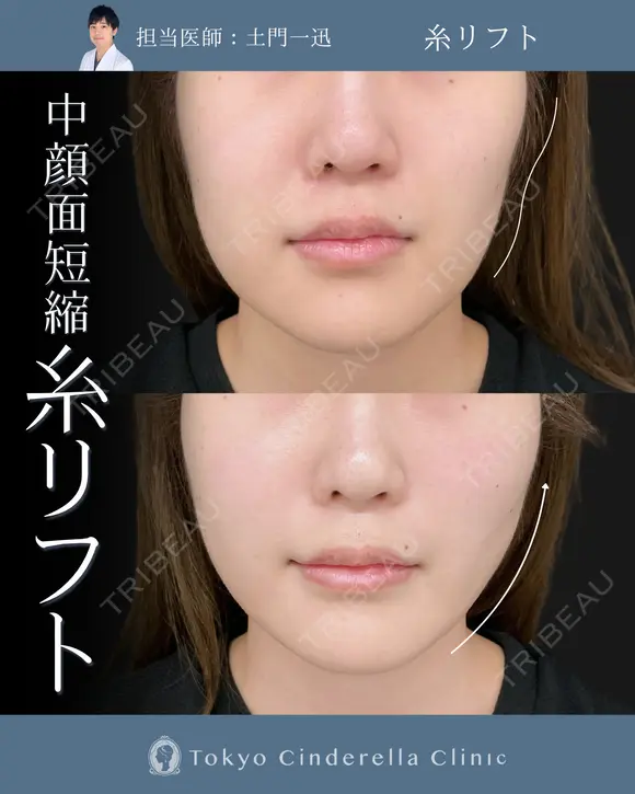 クイックリフト８本 after画像 メイン用
