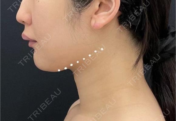 医療ハイフ　全顔 before画像 メイン用