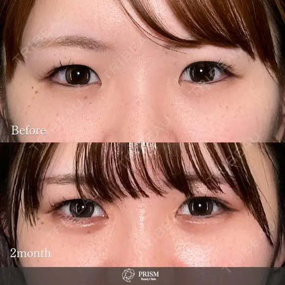 【目頭切開】で離れ目解消！？👀🩷 after画像 メイン用